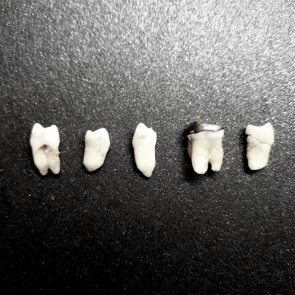 歯列矯正のために抜歯された歯達